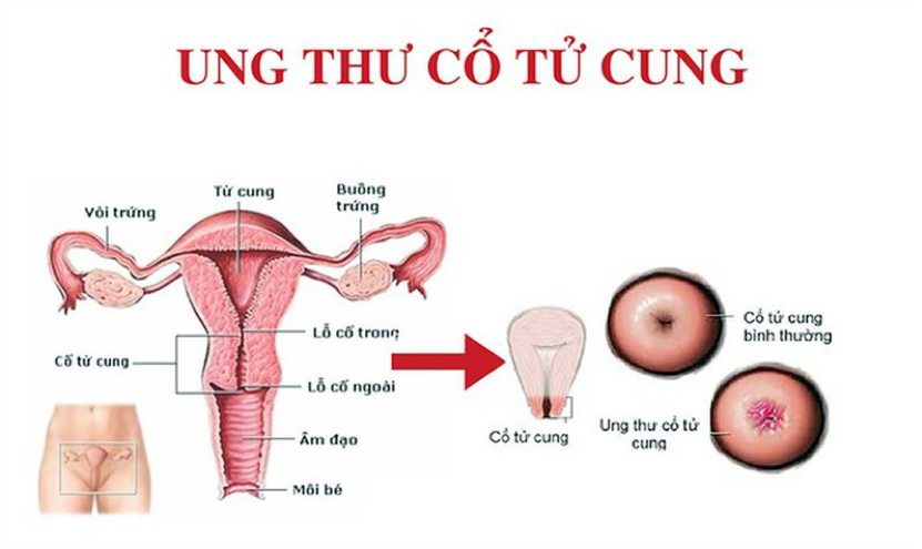 Nguyên nhân và điều kiện gây ra bệnh ung thư