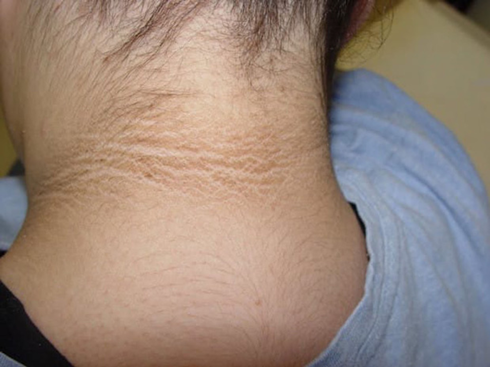 3 thay đổi lạ trên cổ ngầm cảnh báo tế bào ung thư có thể đang chực chờ "trỗi dậy"